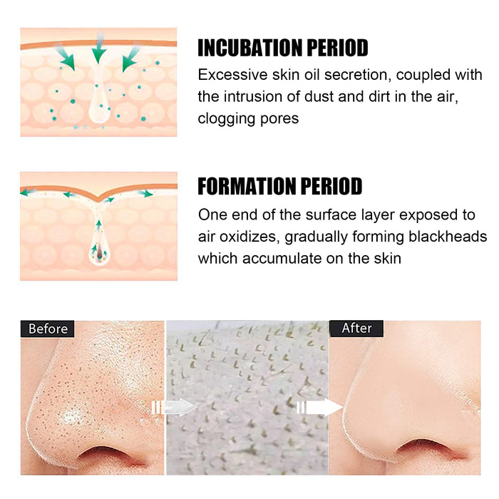 Blackhead Remover Tools -15g Blackhead Creamwith 40Pcs Blackhead Pore Strips